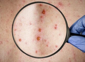 Confirmaron el primer caso de viruela del mono en Mendoza