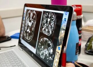Primera neurocirugía funcional por Parkinson en La Matanza