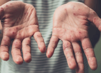 Alerta epidemiológica en Argentina por cuatro casos de sarampión