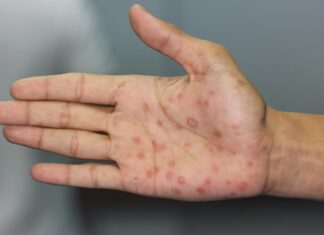 La sífilis alcanza cifras récord en Argentina y el crecimiento preocupa en jóvenes