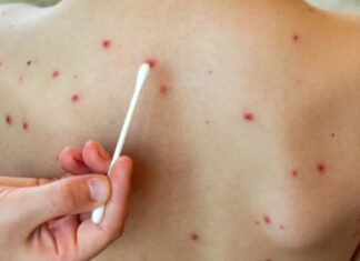 Neuquén recomienda vacunación contra el sarampión tras alerta nacional