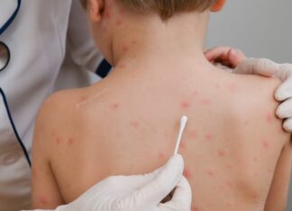 Alerta por sarampión en Argentina: casi 100 personas bajo seguimiento