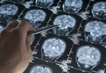 Una gota de sangre podría detectar el Alzheimer antes de los primeros síntomas