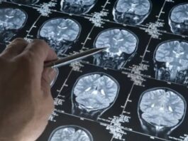 Una gota de sangre podría detectar el Alzheimer antes de los primeros síntomas