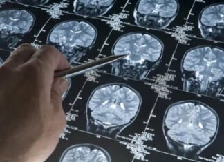 Una gota de sangre podría detectar el Alzheimer antes de los primeros síntomas